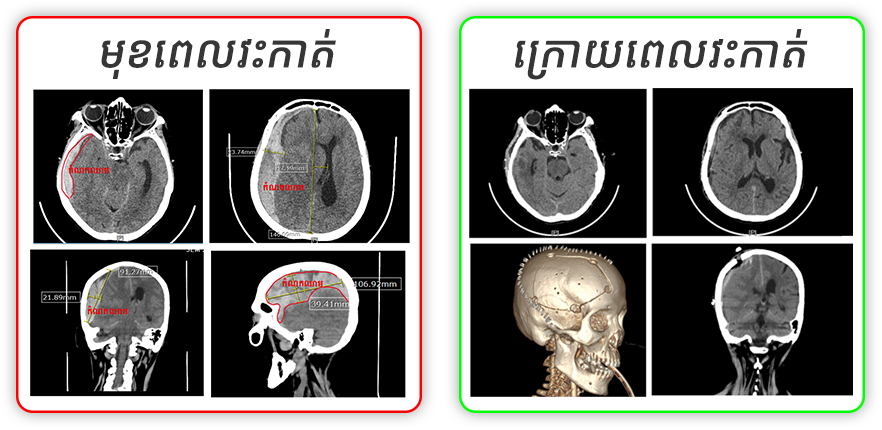 ជោគជ័យដ៏អស្ចារ្យ! មន្ទីរពេទ្យអន្តរជាតិអរៀនដា សង្គ្រោះអ្នកជំងឺឈាមកកក្នុងខួរក្បាលបានជោគជ័យ