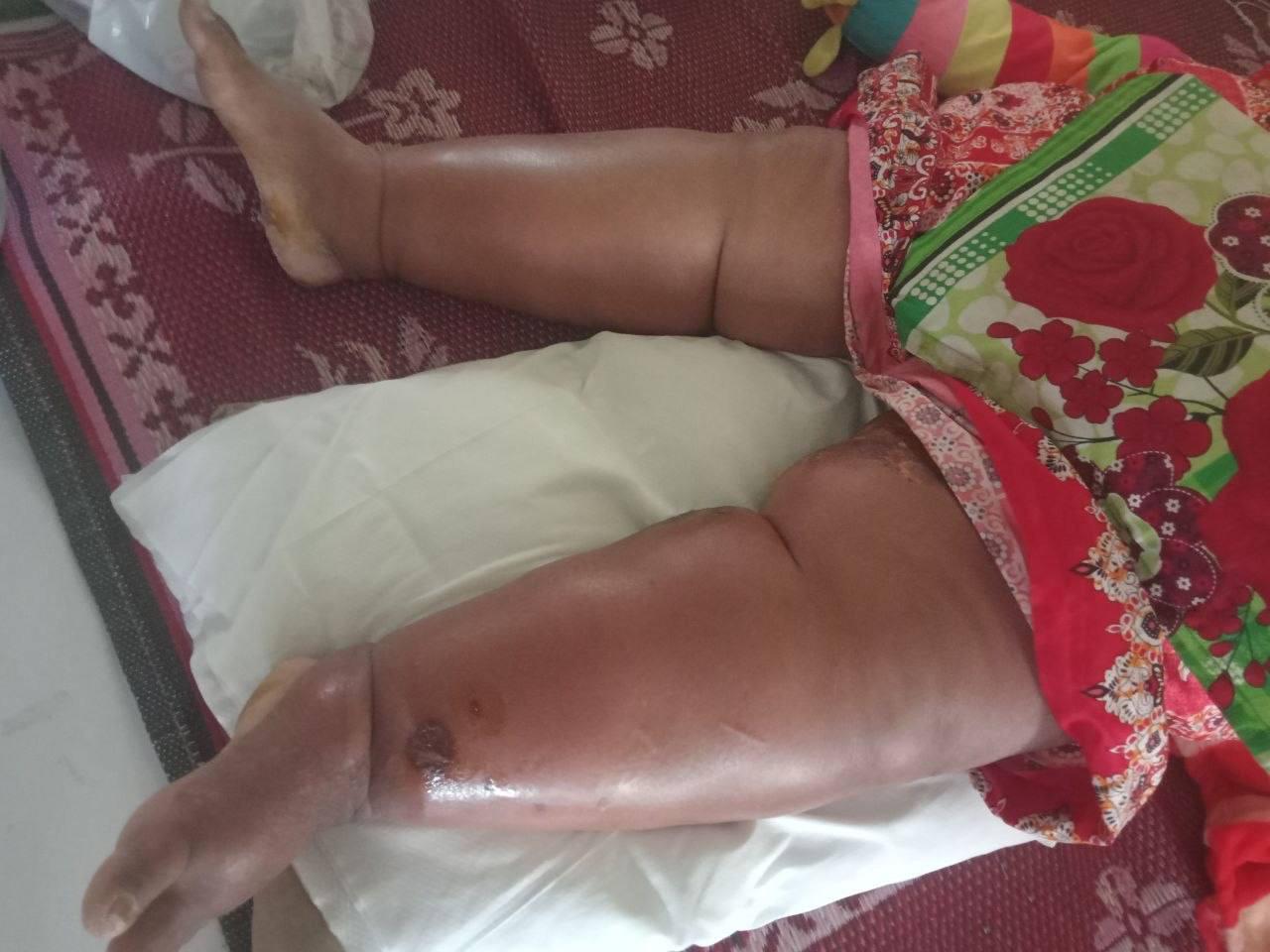 ជំងឺអាថ៌កំបាំង៖ ស្ត្រីចំណាស់ហើមជើងដោយមិនដឹងមូលហេតុ ពេទ្យពិនិត្យមិនឃើញជំងឺ